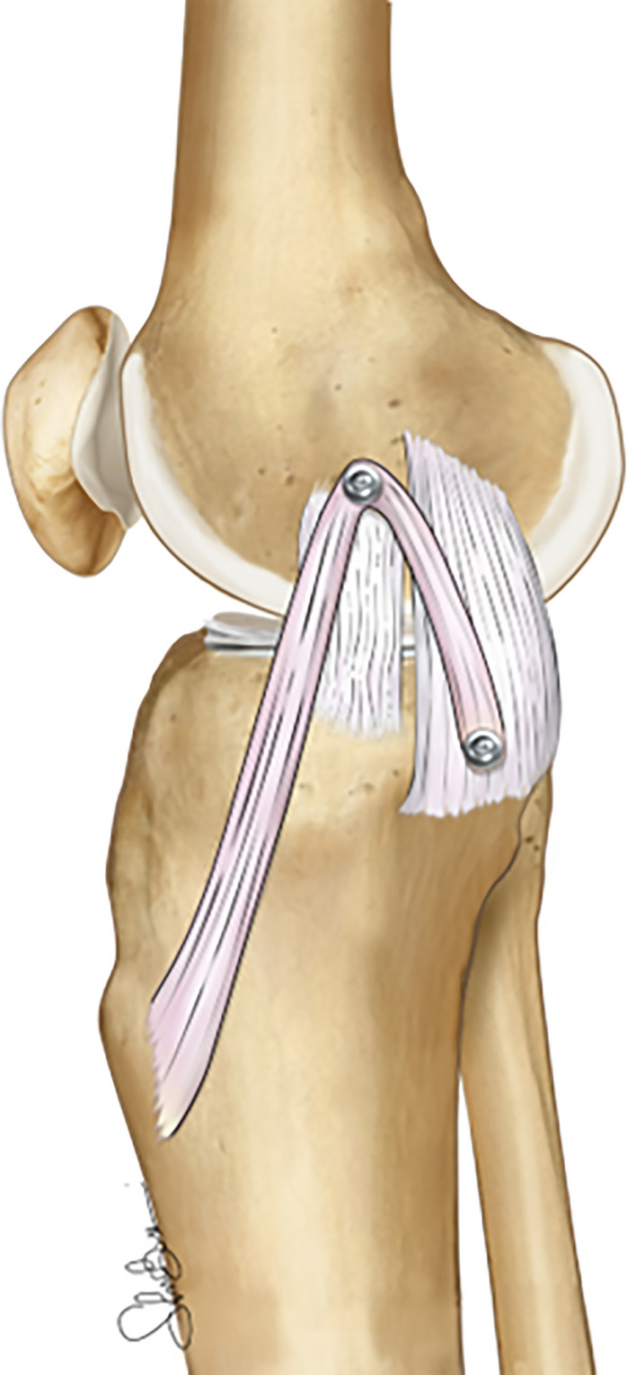 Current trends in the medial side of the knee: not only medial collateral ligament (MCL).