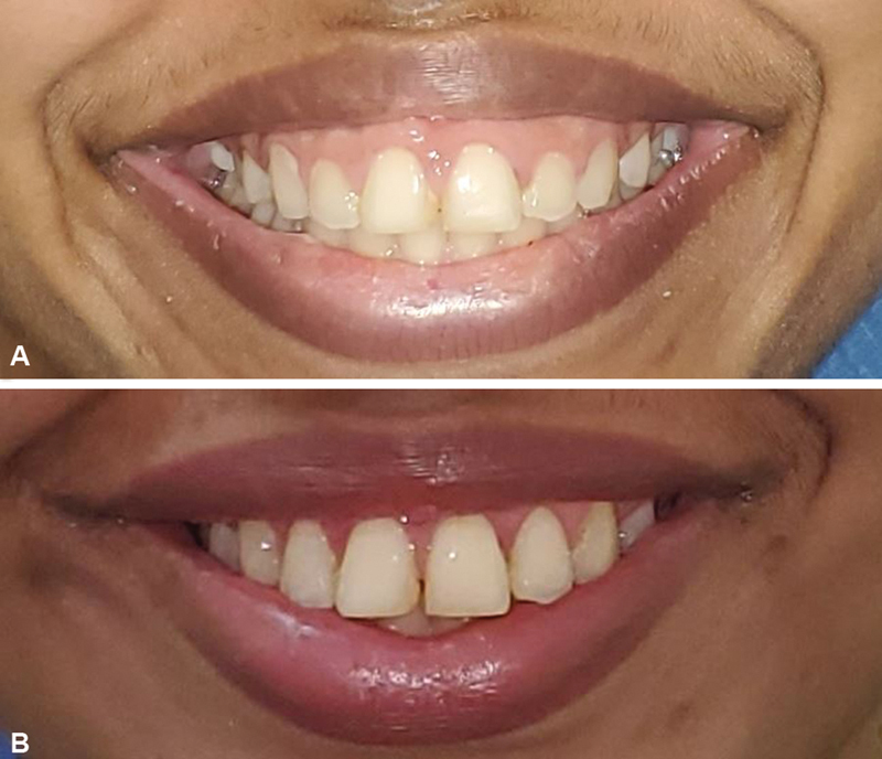 Correction of Gummy Smile: An Essential Procedure in Facial Aesthetics.