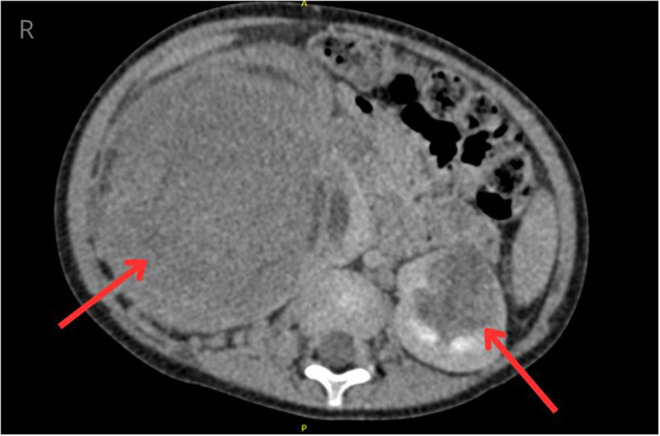 Bilateral Wilms Tumor - Case Report of a Patient with Family History.