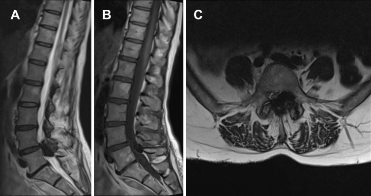 Severe Spinal Stenosis Secondary to a CREST Syndrome Related Calcific Deposit: A Case Report.