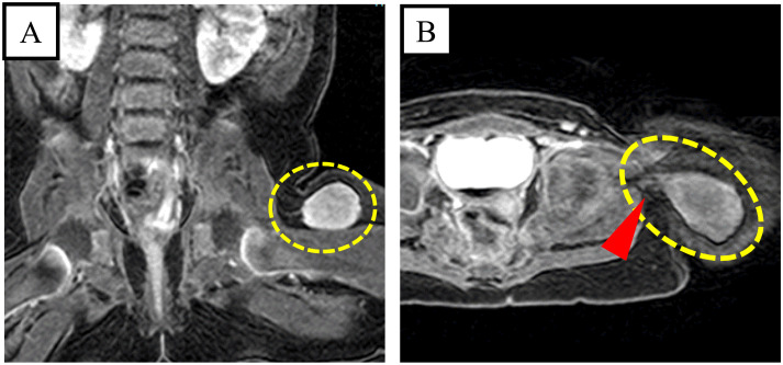 Deep juvenile xanthogranuloma invading the left tensor fasciae latae muscle: a case report and a literature review.