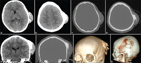 Desmoplastic (collagenous) fibroma of the parietal bone: Case report and review of the literature.