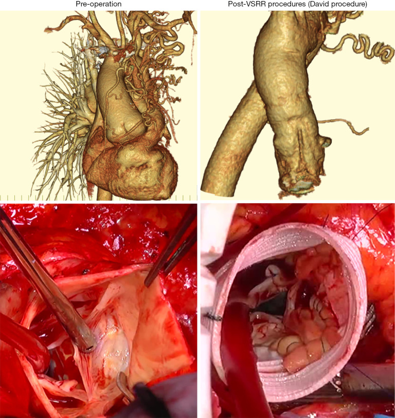 Aortopathy in repaired tetralogy of Fallot and David procedure.