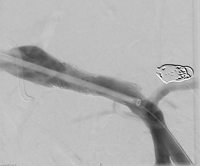 Endovascular Management of a Portal Vein Pseudoaneurysm following Pancreatoduodenectomy: A Case Report and Review of Literature.
