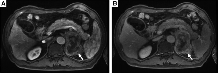 Primary Unilateral Adrenal Anaplastic Large Cell Lymphoma: Remission by Chemotherapy.