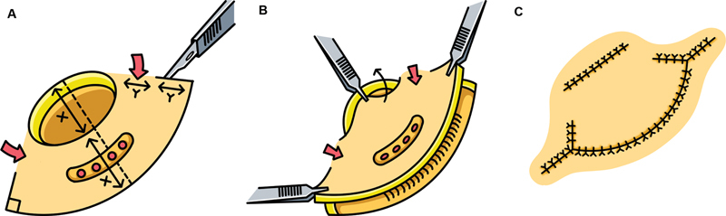 Modified Keystone a Versatile Flap Reconstruction for Mastectomy Defects: Our Clinical Experience.