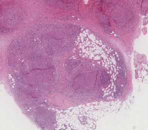 Sarcoidosis-Like Reaction in Melanoma Patients Receiving Immunotherapy or Targeted Therapy.