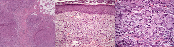 Sarcoidosis-Like Reaction in Melanoma Patients Receiving Immunotherapy or Targeted Therapy.