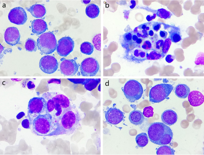 Peripheral Hemophagocytosis and Leukemic Blasts from Urine in De Novo Pure Erythroid Leukemia