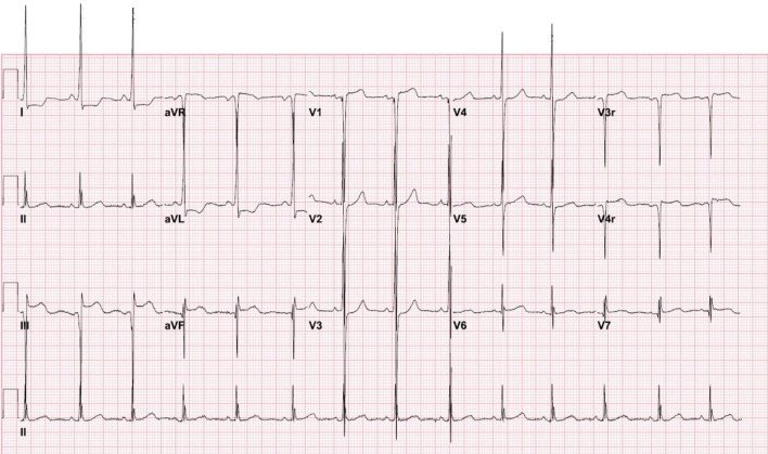 Intraoperative ST Segment Depression During General Anesthesia in a Child: Early Detection of Hypertrophic Cardiomyopathy.