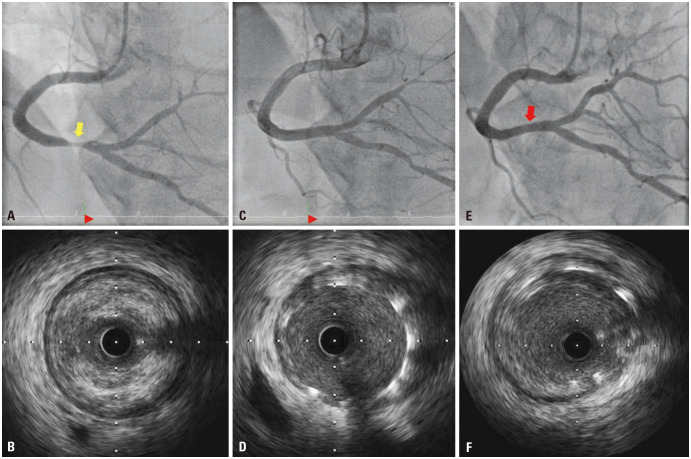 Percutaneous Coronary Intervention and Long-Term Management of Acute Myocardial Infarction in a Hemophilia Patient: Overcoming Bleeding Challenges.