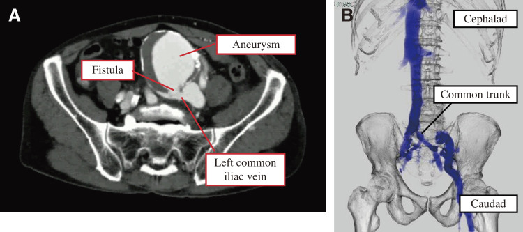 Left Common Iliac Artery Aneurysm Rupture to an Iliac Vein with a Venous Anomaly: A Case Report.