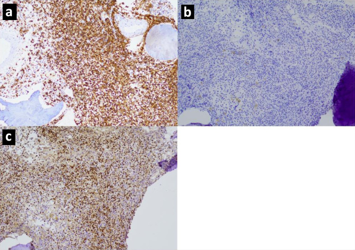 Retrospective Study of CD20 Expression Loss in Relapsed or Refractory B-Cell Non-Hodgkin Lymphoma.