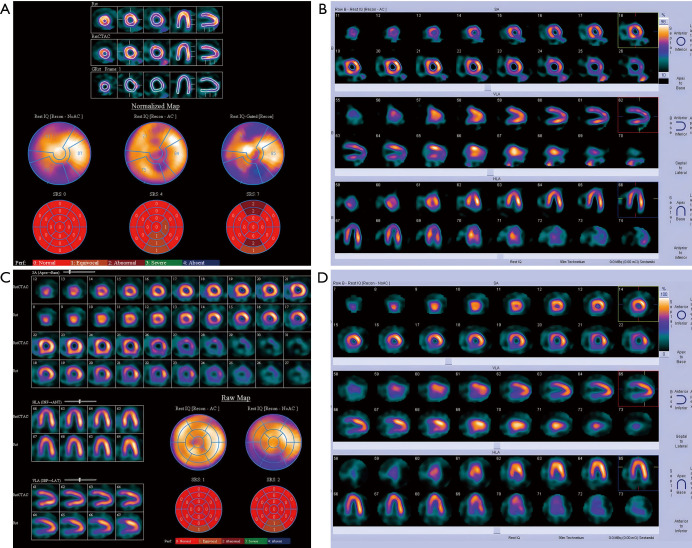 The diagnosis of eosinophilic granulomatosis with polyangiitis has been 'masked' by asthma: a case report.