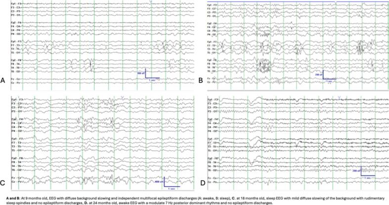Favorable response to ketogenic diet therapy in a patient with DYNC1H1-related epilepsy
