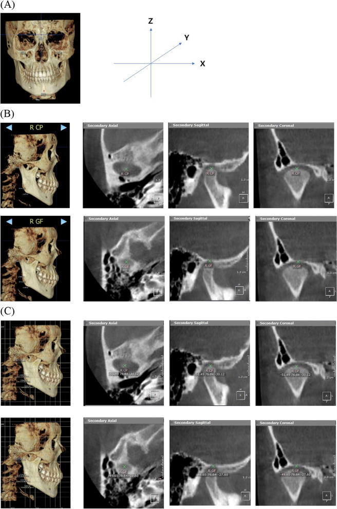 Condylar position changes and prognosis in patients with unilateral mandibular condylar fracture treated non-surgically.