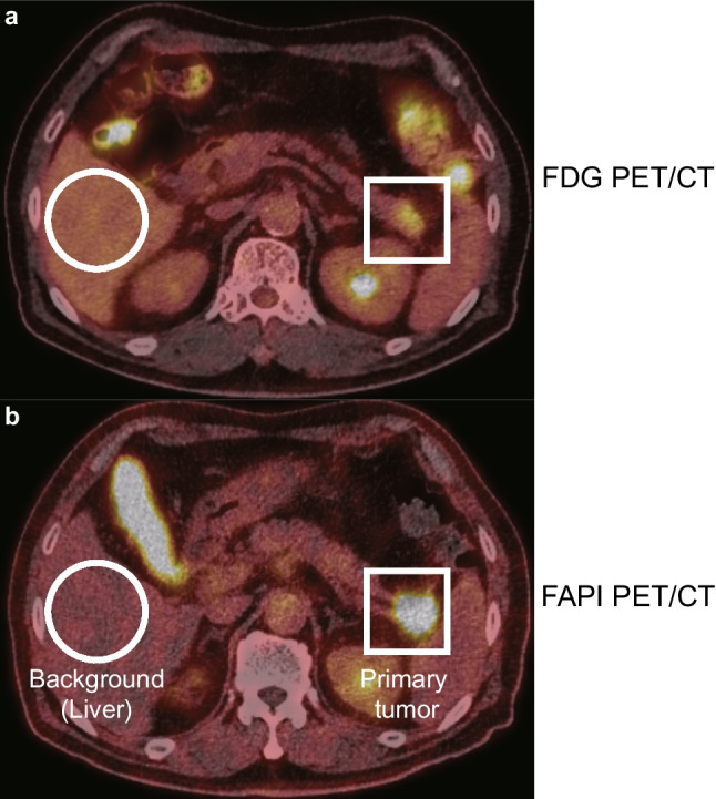Prospective Comparison of [<sup>18</sup>F]FDG and [<sup>18</sup>F]AIF-FAPI-74 PET/CT in the Evaluation of Potentially Resectable Pancreatic Ductal Adenocarcinoma.