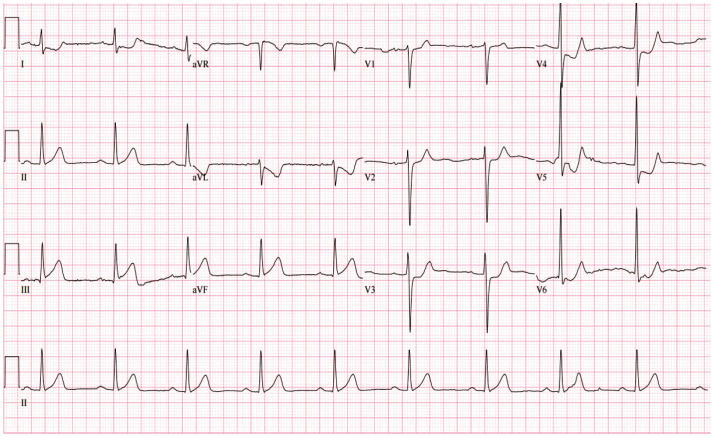 Percutaneous Coronary Intervention and Long-Term Management of Acute Myocardial Infarction in a Hemophilia Patient: Overcoming Bleeding Challenges.