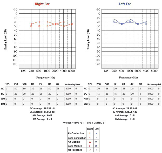 Pediatric Usher Syndrome Type 2A with Coexisting Rheumatic Heart Disease and Upper Gastro-Intestinal Bleed: A Case Report.