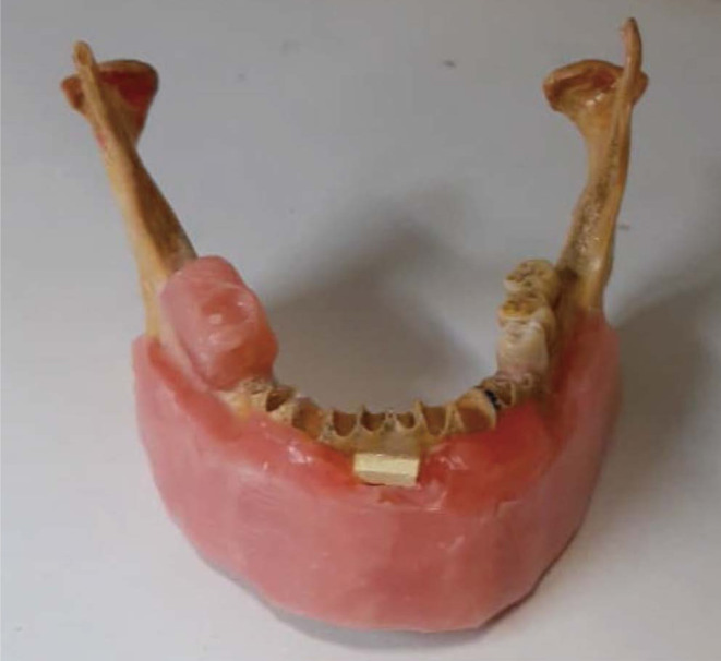 Effect of a metal artifact reduction algorithm on cone-beam computed tomography scans of titanium and zirconia implants within and outside the field of view.