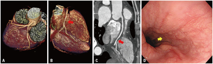 Percutaneous Coronary Intervention and Long-Term Management of Acute Myocardial Infarction in a Hemophilia Patient: Overcoming Bleeding Challenges.
