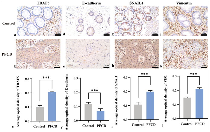 Tumor necrosis factor receptor-associated factor 5 enhances perianal fistulizing Crohn's disease through epithelial-mesenchymal transition.