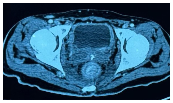 The unseen spread-Schnitzler's metastasis unveiled: a case report.