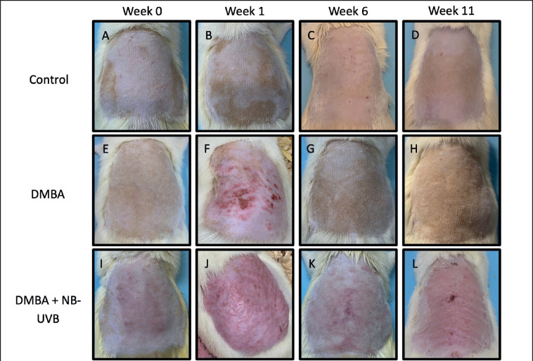 Effect of narrowband ultraviolet B (311 nm) exposure on skin carcinogenesis in Wistar rats.