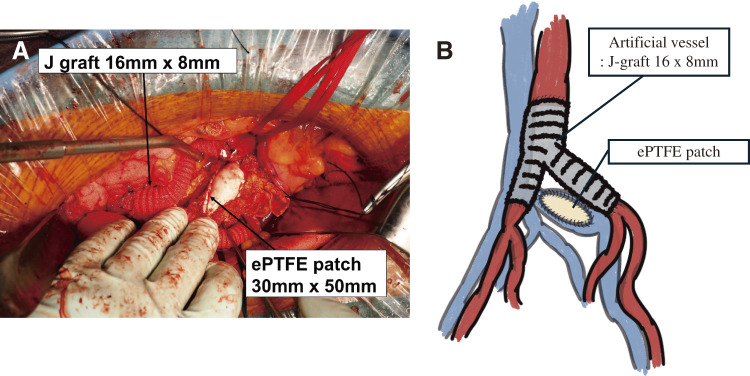 Left Common Iliac Artery Aneurysm Rupture to an Iliac Vein with a Venous Anomaly: A Case Report.