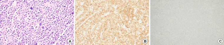 Anaplastic lymphoma kinase-negative primary systemic anaplastic large cell lymphoma mimicking a ruptured epidermal cyst of the scalp: a case report and literature review.