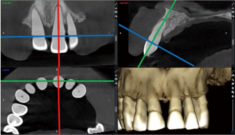 Validation of novel measurement protocols proposed for the standardized assessment of crestal bone levels: A cone-beam computed tomography study.