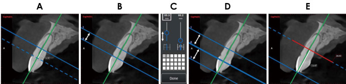 Validation of novel measurement protocols proposed for the standardized assessment of crestal bone levels: A cone-beam computed tomography study.