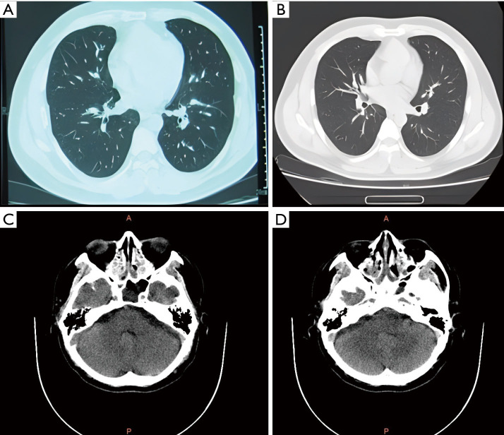The diagnosis of eosinophilic granulomatosis with polyangiitis has been 'masked' by asthma: a case report.
