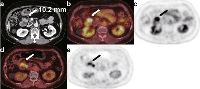 Prospective Comparison of [<sup>18</sup>F]FDG and [<sup>18</sup>F]AIF-FAPI-74 PET/CT in the Evaluation of Potentially Resectable Pancreatic Ductal Adenocarcinoma.