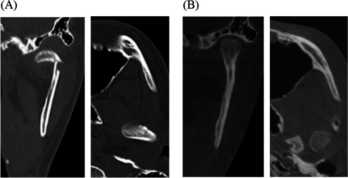 Condylar position changes and prognosis in patients with unilateral mandibular condylar fracture treated non-surgically.