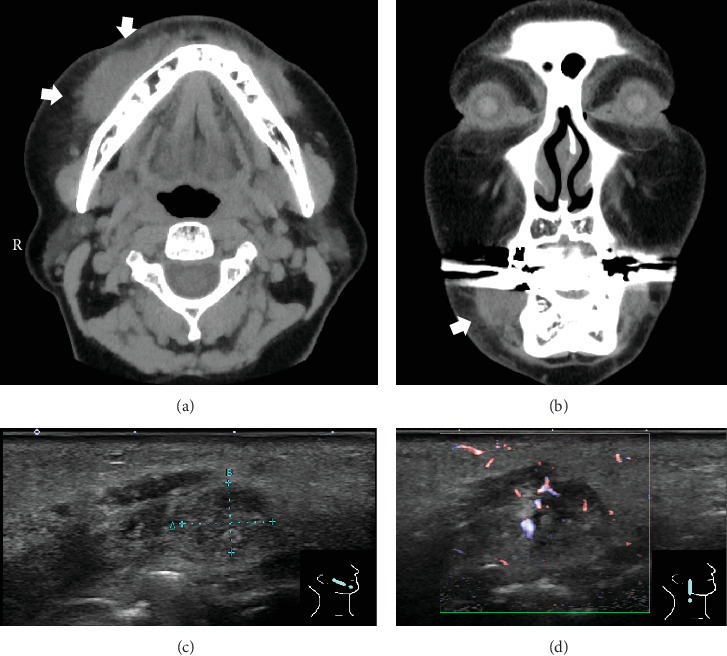 Histological Features of Delayed Foreign Body Granuloma With Epithelioid Histiocyte Aggregation and Eosinophilic Reaction due to Hyaluronic Acid Injection.