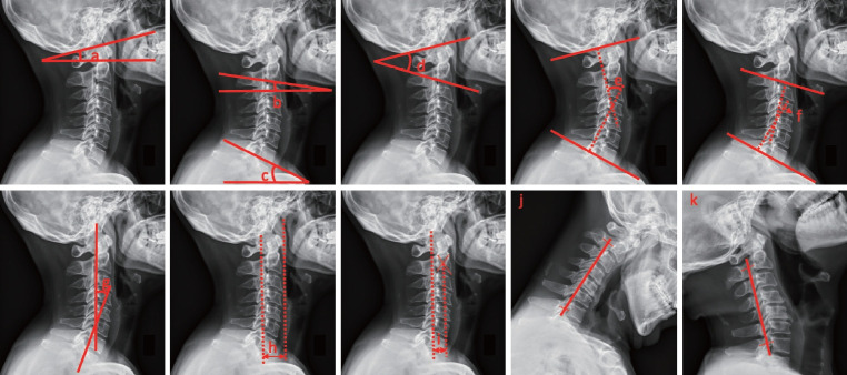 Predicting Neck Dysfunction After Open-Door Cervical Laminoplasty - A Prospective Cohort Patient-Reported Outcome Measurement Study.