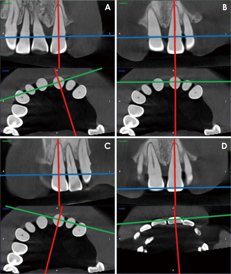 Validation of novel measurement protocols proposed for the standardized assessment of crestal bone levels: A cone-beam computed tomography study.