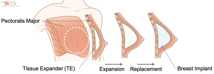 Updates on Breast Reconstruction: Surgical Techniques, Challenges, and Future Directions.