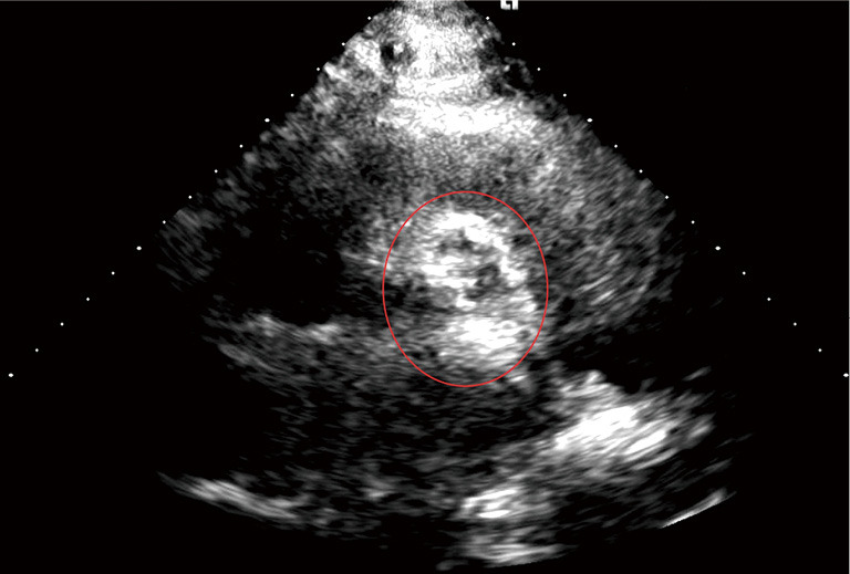 A computer vision model for the identification and scoring of calcium in aortic valve stenosis: a single-center experience.