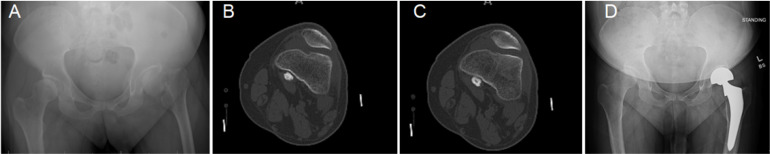 Hemiarthroplasty for Hip Fracture in Down Syndrome: A Retrospective Series of Five Cases.