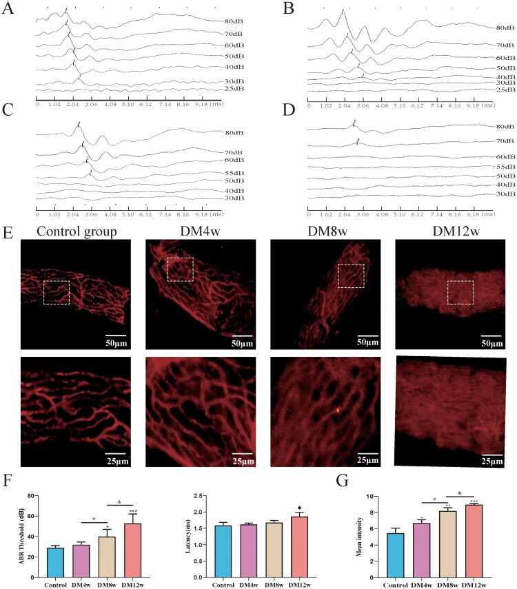 Hyperglycemia-induced oxidative stress exacerbates mitochondrial apoptosis damage to cochlear stria vascularis pericytes via the ROS-mediated Bcl-2/CytC/AIF pathway.