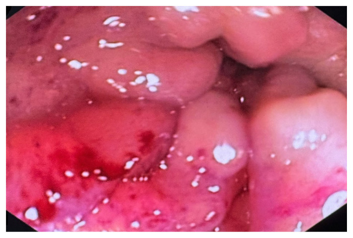 The unseen spread-Schnitzler's metastasis unveiled: a case report.