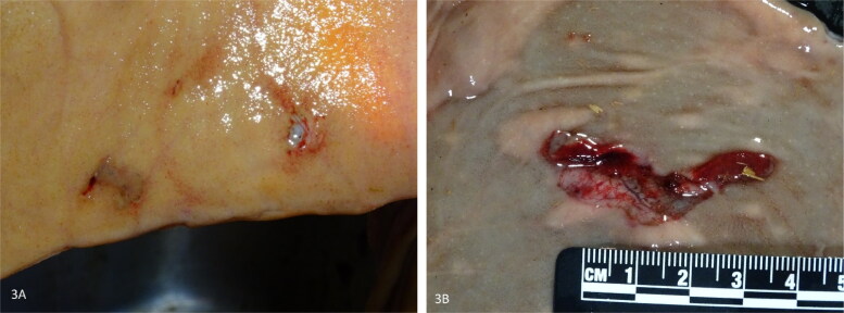 Characterization of early-stage lesions and investigation on the role of mucosal trauma in hemorrhagic bowel syndrome in cattle.