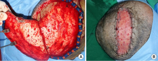 Anaplastic lymphoma kinase-negative primary systemic anaplastic large cell lymphoma mimicking a ruptured epidermal cyst of the scalp: a case report and literature review.