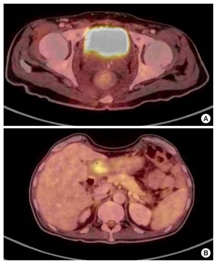 The unseen spread-Schnitzler's metastasis unveiled: a case report.