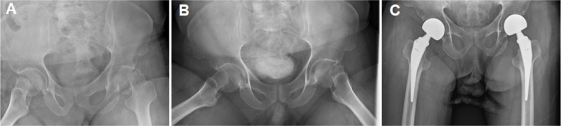 Hemiarthroplasty for Hip Fracture in Down Syndrome: A Retrospective Series of Five Cases.