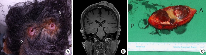 Anaplastic lymphoma kinase-negative primary systemic anaplastic large cell lymphoma mimicking a ruptured epidermal cyst of the scalp: a case report and literature review.