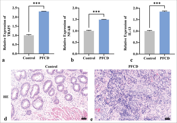 Tumor necrosis factor receptor-associated factor 5 enhances perianal fistulizing Crohn's disease through epithelial-mesenchymal transition.