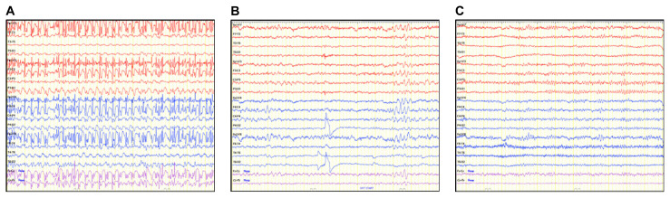 New Onset Absence Status Epilepticus in Pregnancy: A Case Report.